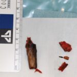 Drewno w policzku dziecka przez 2 miesiące. Lekarze z Katowic dokonali cudu!