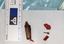 Drewno w policzku dziecka przez 2 miesiące. Lekarze z Katowic dokonali cudu!